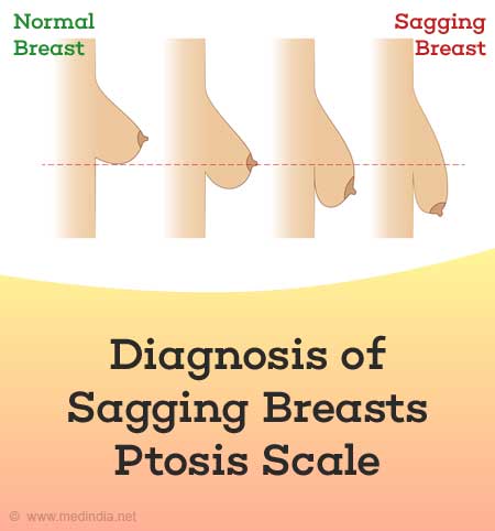 Saggy Breasts (Breast Ptosis): Causes & Treatments