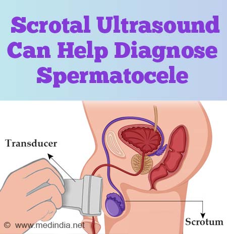 Spermatocele: Causes, Symptoms, Diagnosis & Treatment