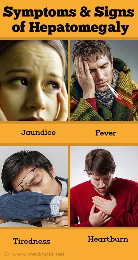 Hepatomegaly Causes Symptoms Diagnosis Treatment Prevention Hepatomegaly Causes Symptoms Diagnosis Treatment Prevention