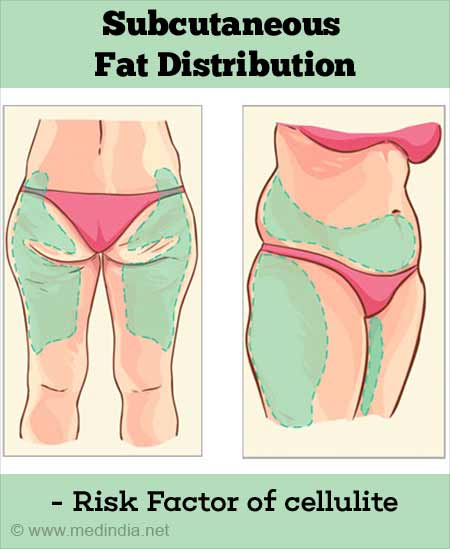 Cellulite Treatment - Causes, Risk Factors, Treatment, Alternative