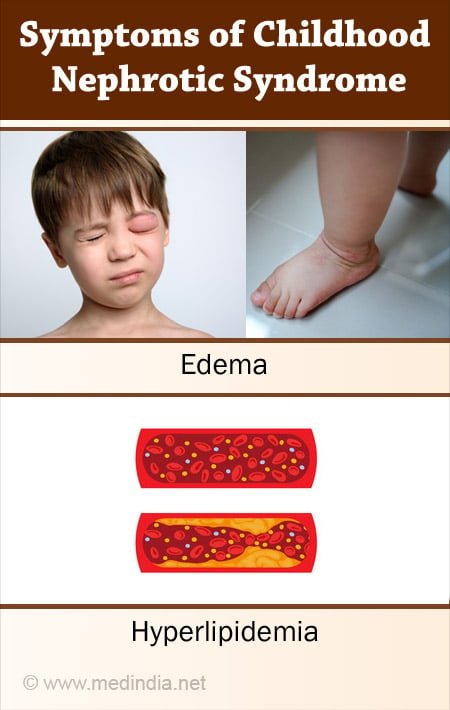 nephrotic syndrome edema
