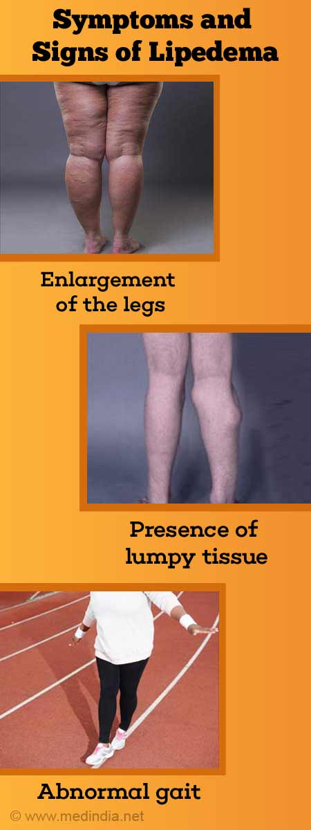 Lipedema  Fat Disorder - Causes, Stages, Symptoms, Diagnosis