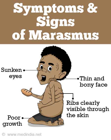 Marasmus | Protein-Energy Malnutrition - Causes, Symptoms, Diagnosis,  Treatment and Prevention