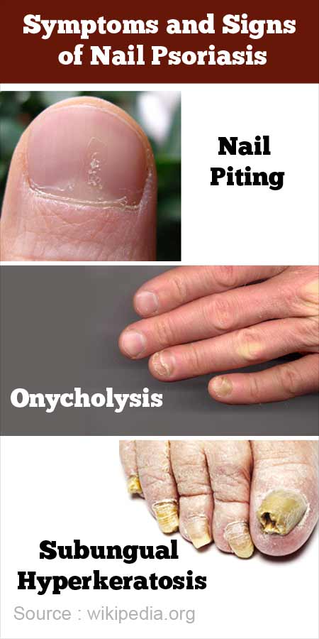 Psoriasis in the fingernails and toenails