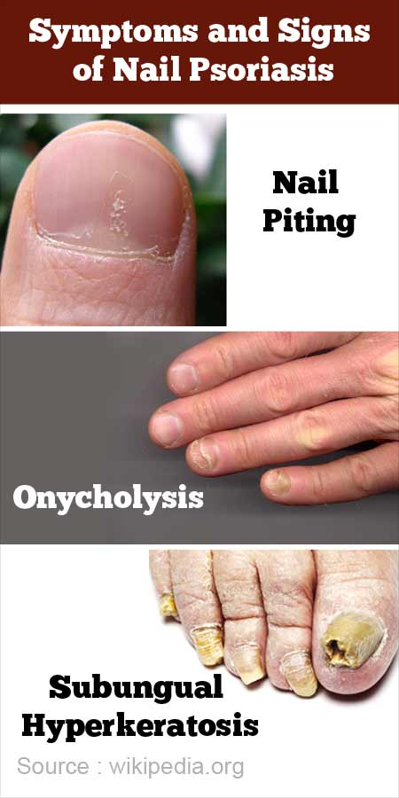 onycholysis psoriasis