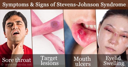 mild steven johnson syndrome