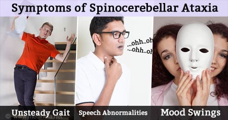 Spinocerebellar Ataxia - Types, Causes, Symptoms, Diagnosis ...