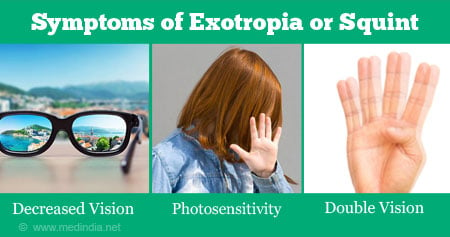 Exotropia Types Symptoms Diagnosis Treatment Prevention