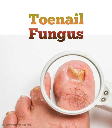 Tinea unguium: etiology, clinical manifestation, diagnosis and treatment -  Online Biology Notes