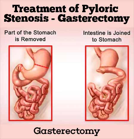 Treatment Of Pyloric Stenosis In Adults