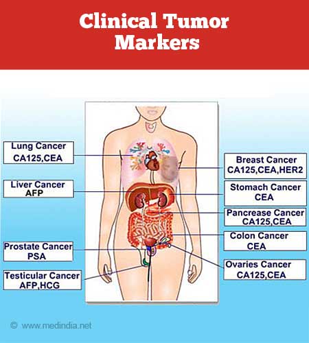 prostate cancer diagnosis tumor marker)