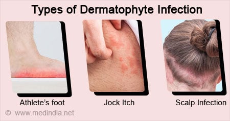 Dermatophyte Infection: What Is It, Causes, Signs and Symptoms