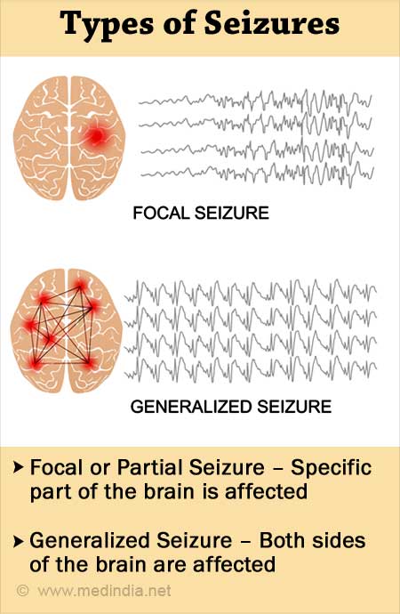 seizure types