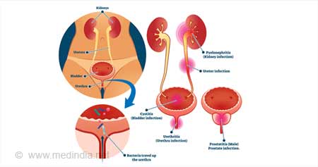 Is That Burning Sensation a Urinary Tract Infection?