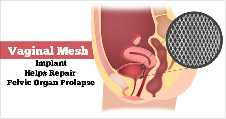 Pelvic Organ Prolapse - Types, Causes, Symptoms, Diagnosis, Treatment &  Prevention