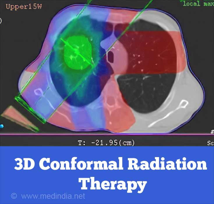 Three Dimensional Conformal Radiation Therapy Three Dimensional Conformal Radiation Therapy