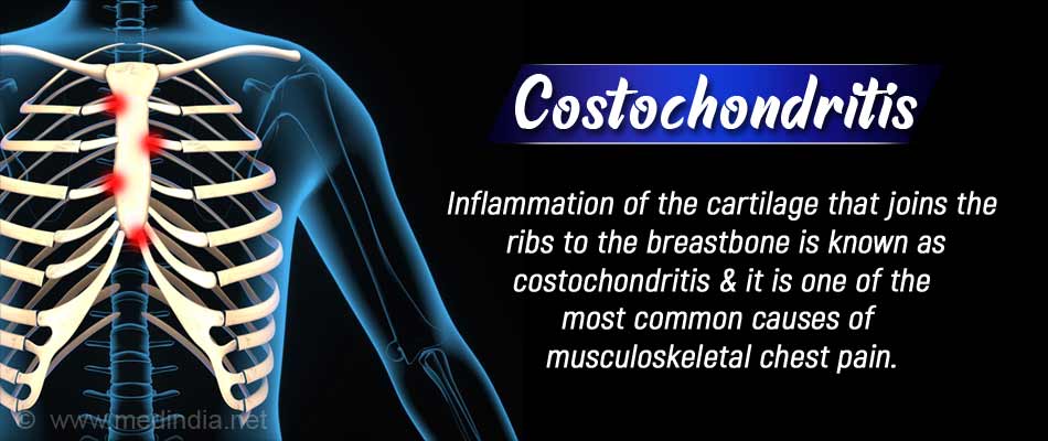 Costochondritis Intercostal Muscles