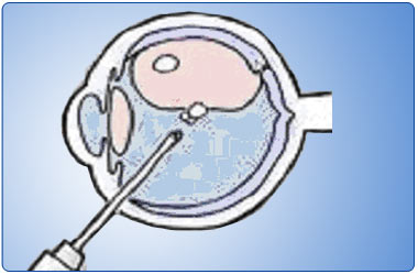 Pneumatic Retinopexy Pneumatic Retinopexy