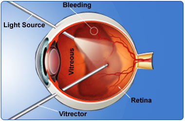 Vitrectomy Vitrectomy