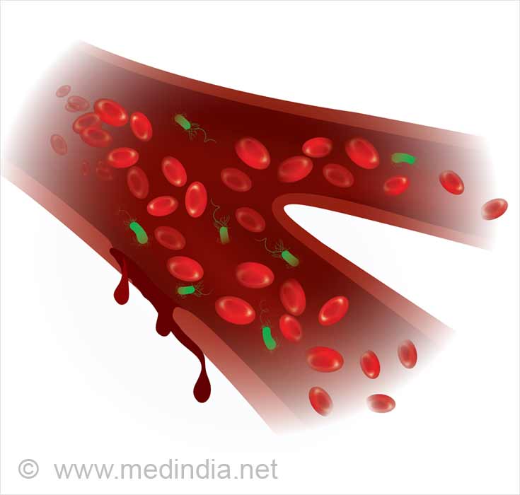 Septicemia / Sepsis Septicemia / Sepsis