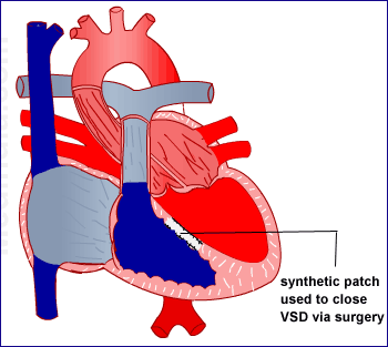 Atrial Septal Defect (ASD) Atrial Septal Defect (ASD)