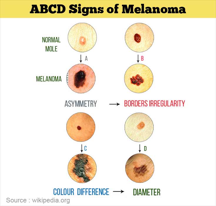 Malignant Melanoma Symptoms And Signs Understanding T
