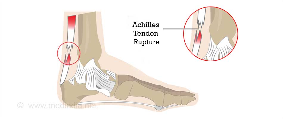 Heel Pain - Symptom Evaluation - Causes, Diagnosis, Treatment, Helth ...