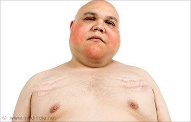 Adrenal Gland Disorders: Cushing's Syndrome Adrenal Gland Disorders: Cushing's Syndrome