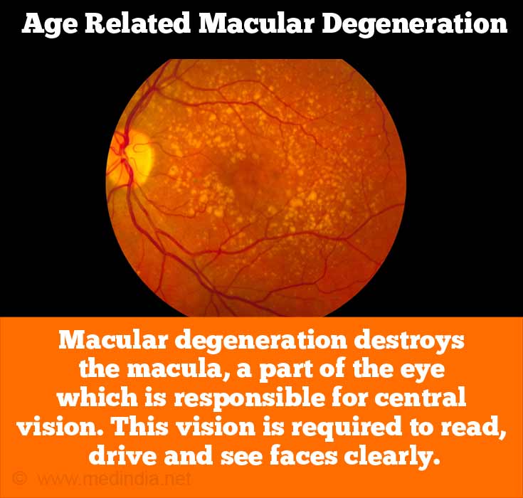 Age Related Macular Degeneration Age Related Macular Degeneration