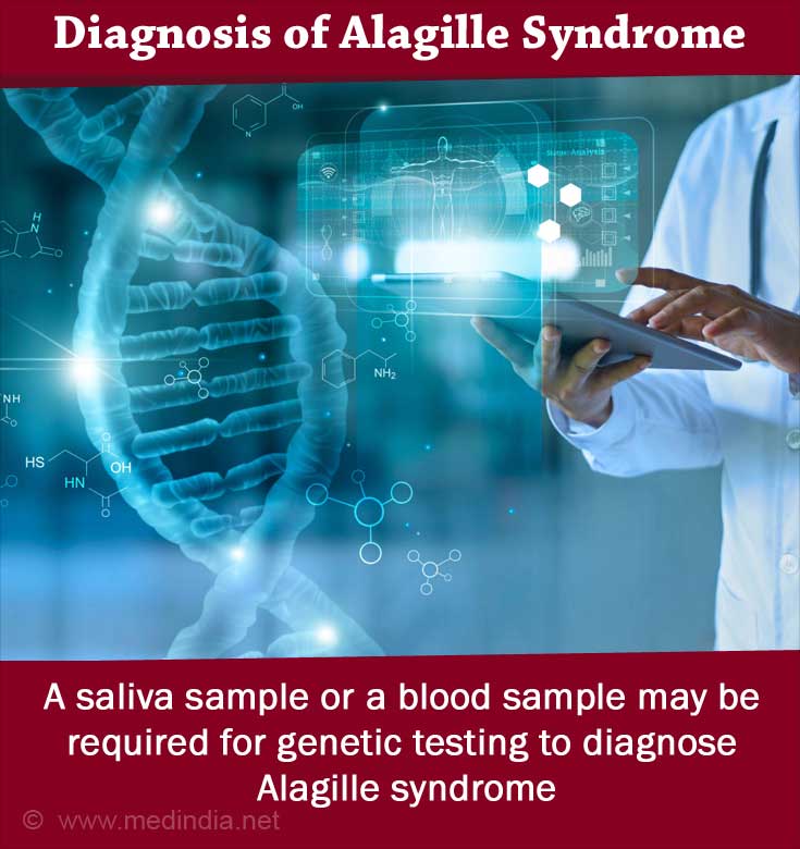 Alagille Syndrome Diagnosis Alagille Syndrome Diagnosis