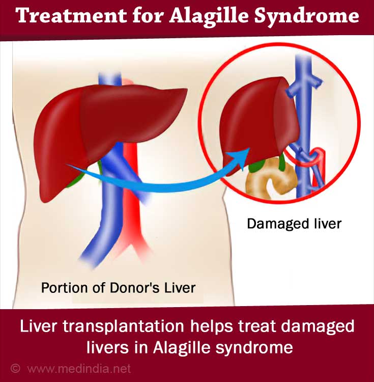 Alagille Syndrome (AGS) - Causes, Symptoms, Diagnosis, Treatment ...