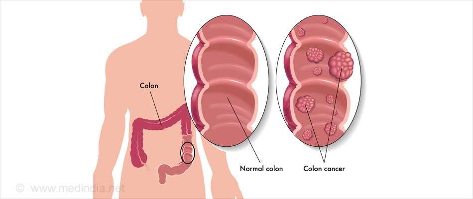 Risk of Aloe Vera: Colorectal Cancer Risk of Aloe Vera: Colorectal Cancer