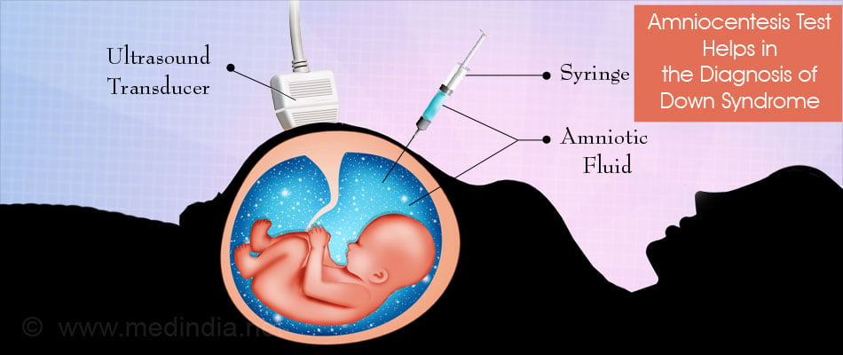 down-syndrome-trisomy-21-causes-symptoms-diagnosis-treatment