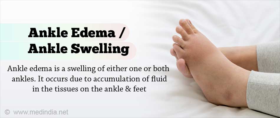 Ankle Edema / Ankle Swelling - Causes FAQs