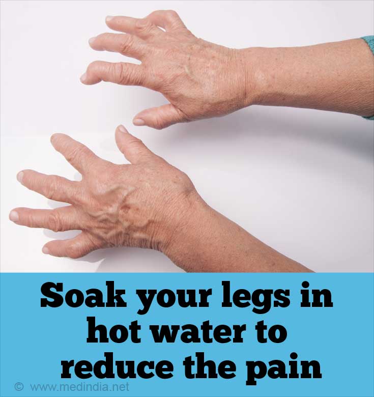 Arthritis Arthritis