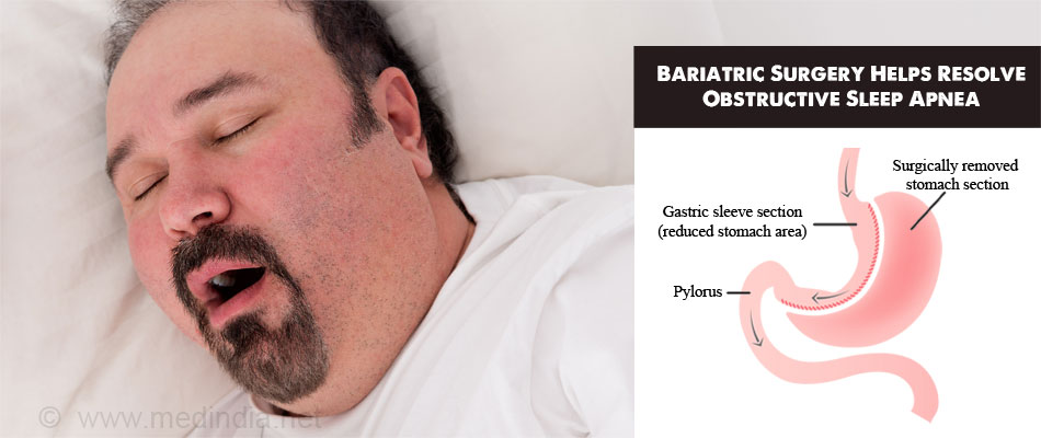 Bariatric Surgery Helps Resolve Obstructive Sleep Apnea Bariatric Surgery Helps Resolve Obstructive Sleep Apnea