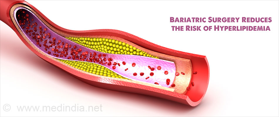 Bariatric Surgery Reduces the Risk of Hyperlipidemia Bariatric Surgery Reduces the Risk of Hyperlipidemia