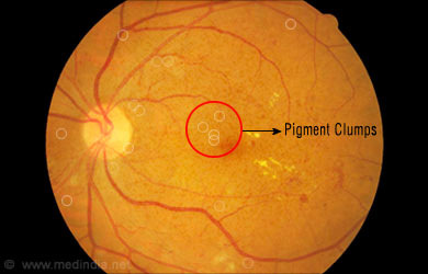 Bietti Crystalline Dystrophy Pigment Clumps Bietti Crystalline Dystrophy Pigment Clumps
