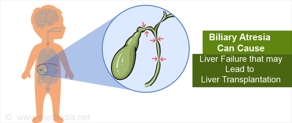 Common Types of Liver diseases leading to Liver Transplantation