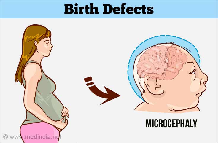 Birth Defects - Types, Causes, Diagnosis, Prevention, Treatment