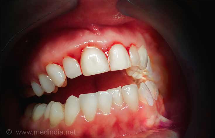 Bleeding Gums Causes Symptoms Diagnosis Treatment