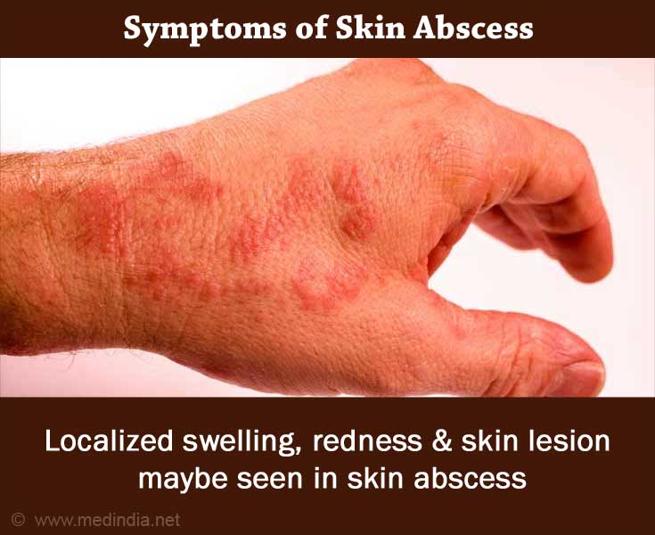 Boils | Skin Abscess - Causes, Symptoms, Diagnosis, Treatment