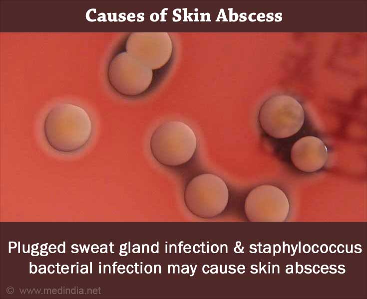 Boils Skin Abscess Causes Symptoms Diagnosis Treatment