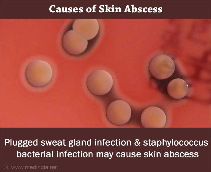 Boils Skin Abscess Causes Symptoms Diagnosis Treatment 