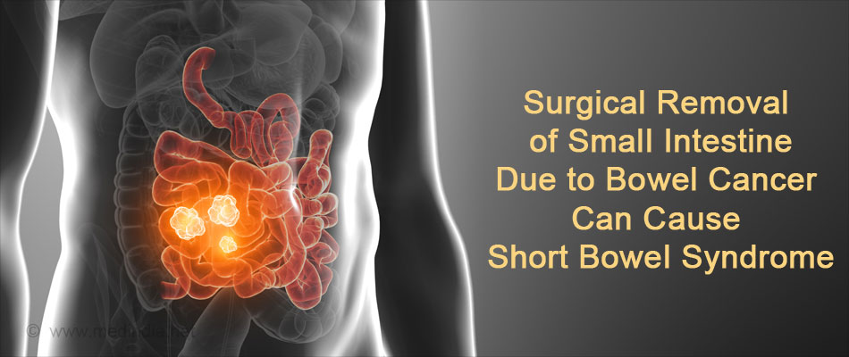 Surgical Remvoal of Small Intestine Due to Bowel Cancer Can Cause Short Bowel Syndrome
