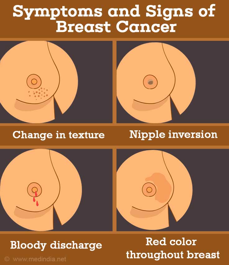 What Are the Symptoms and Signs of Breast Cancer?