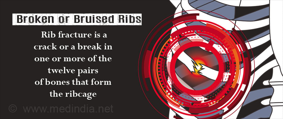 Broken or Bruised Ribs - Types, Causes, Symptoms, Risks, Complications ...