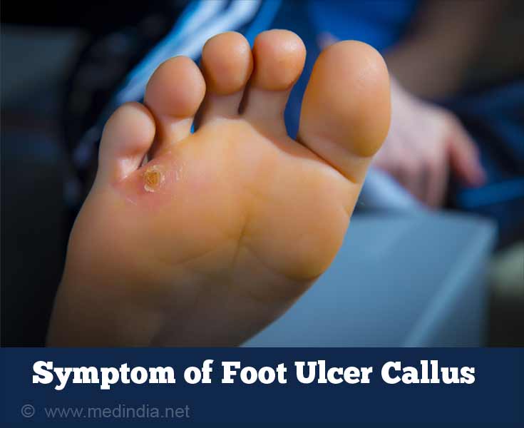 Pre-Ulcerative Callus: What are they and how do you prevent them