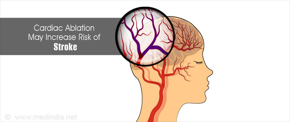Risk of Cardiac Ablation - Stroke Risk of Cardiac Ablation - Stroke