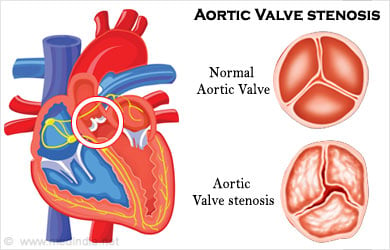 Recent Advancements in Cardiac Surgery